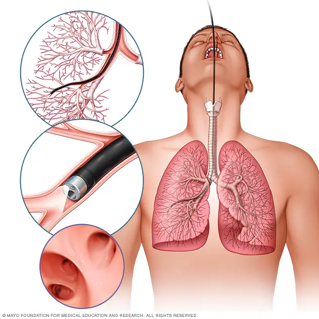 mcdc7 bronchoscopy 8col